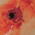 TrueClot - Wound Packing Training Kit, Gunshot Wound with Bone